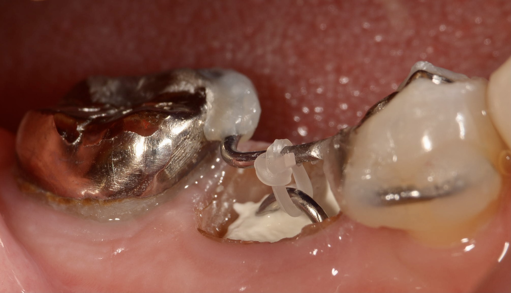 エクストルージョン法により他院で抜歯と診断された歯を保存した症例