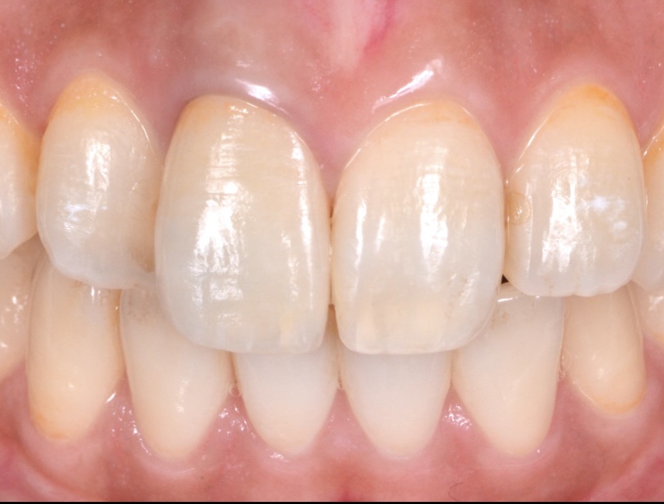 56エクストルージョン法により他院で抜歯と診断された歯を保存した症例