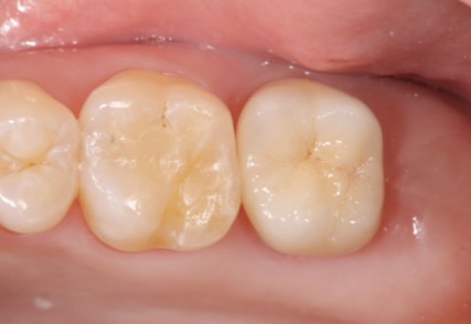 89セラミッククラウンにより歯茎の黒ずみを改善した症例
