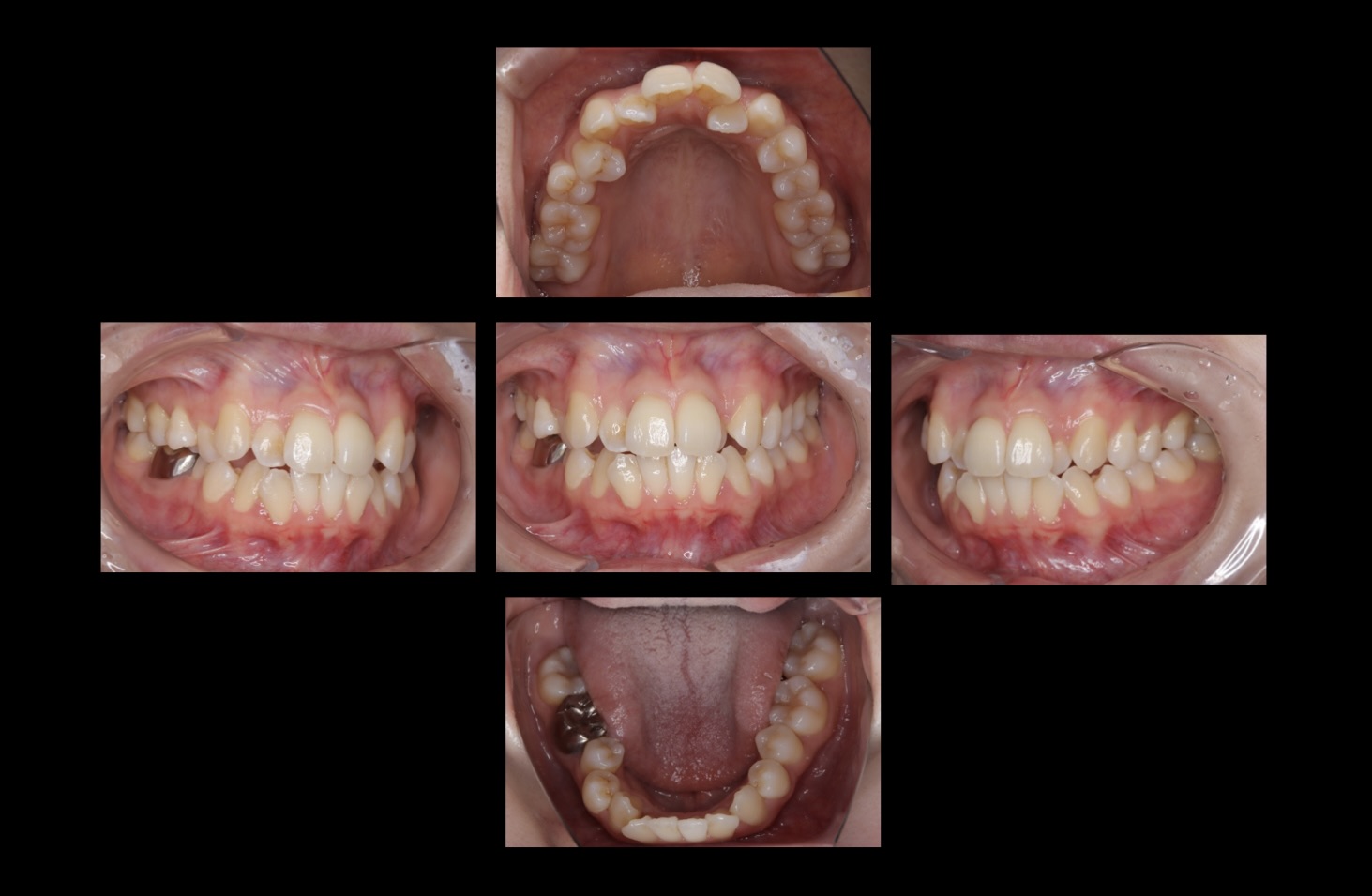 206前歯の矯正治療をマウスピース矯正で行なった症例