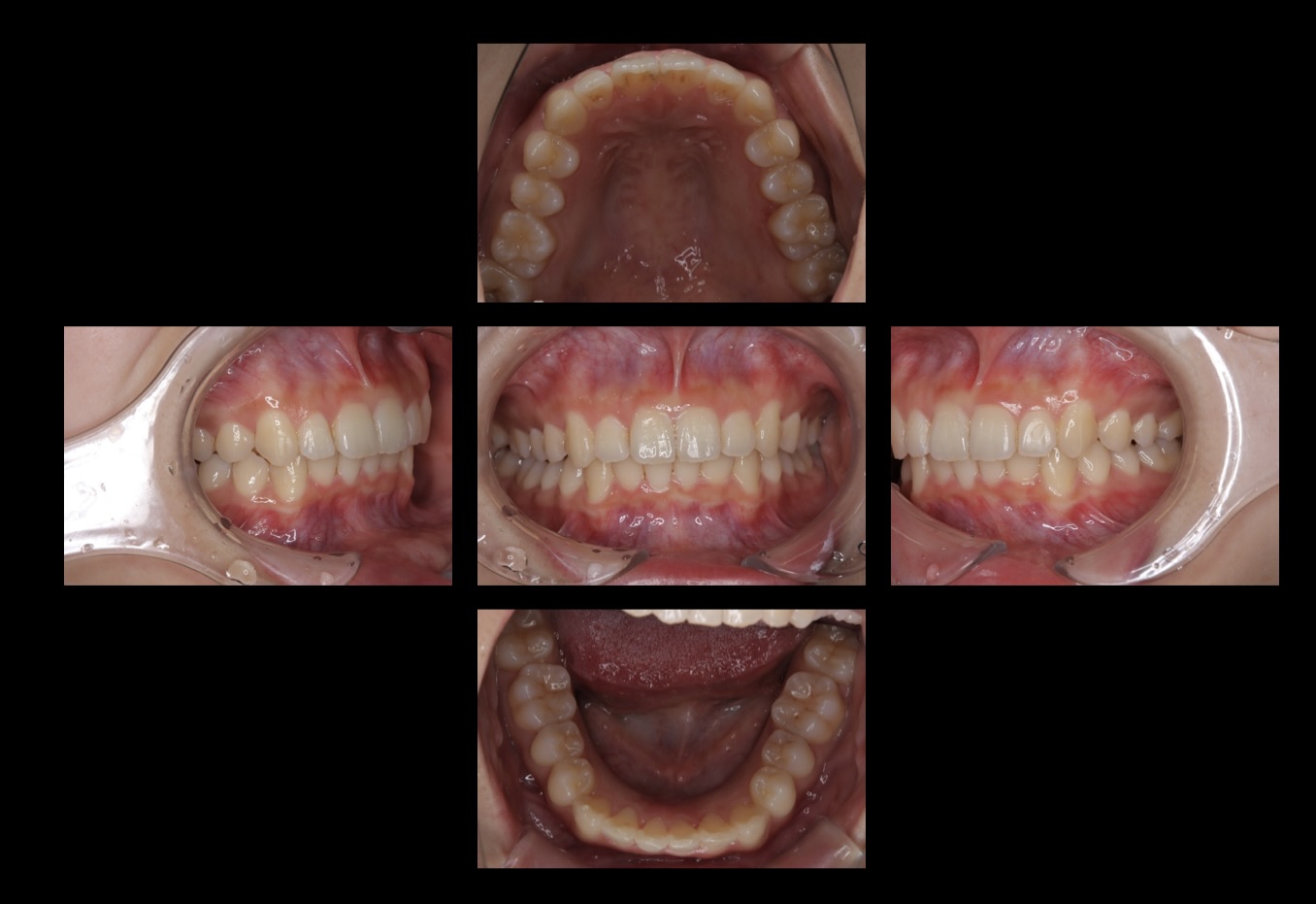 246歯と歯の隙間をインビザラインGo（マウスピース矯正）で治療をした症例