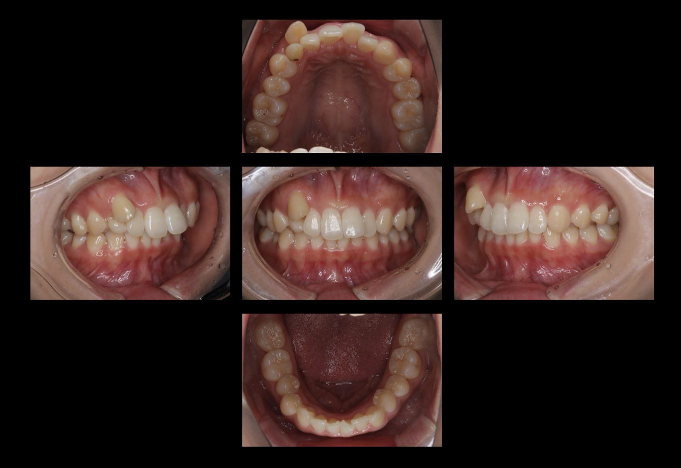 インビザラインで矯正治療をした症例