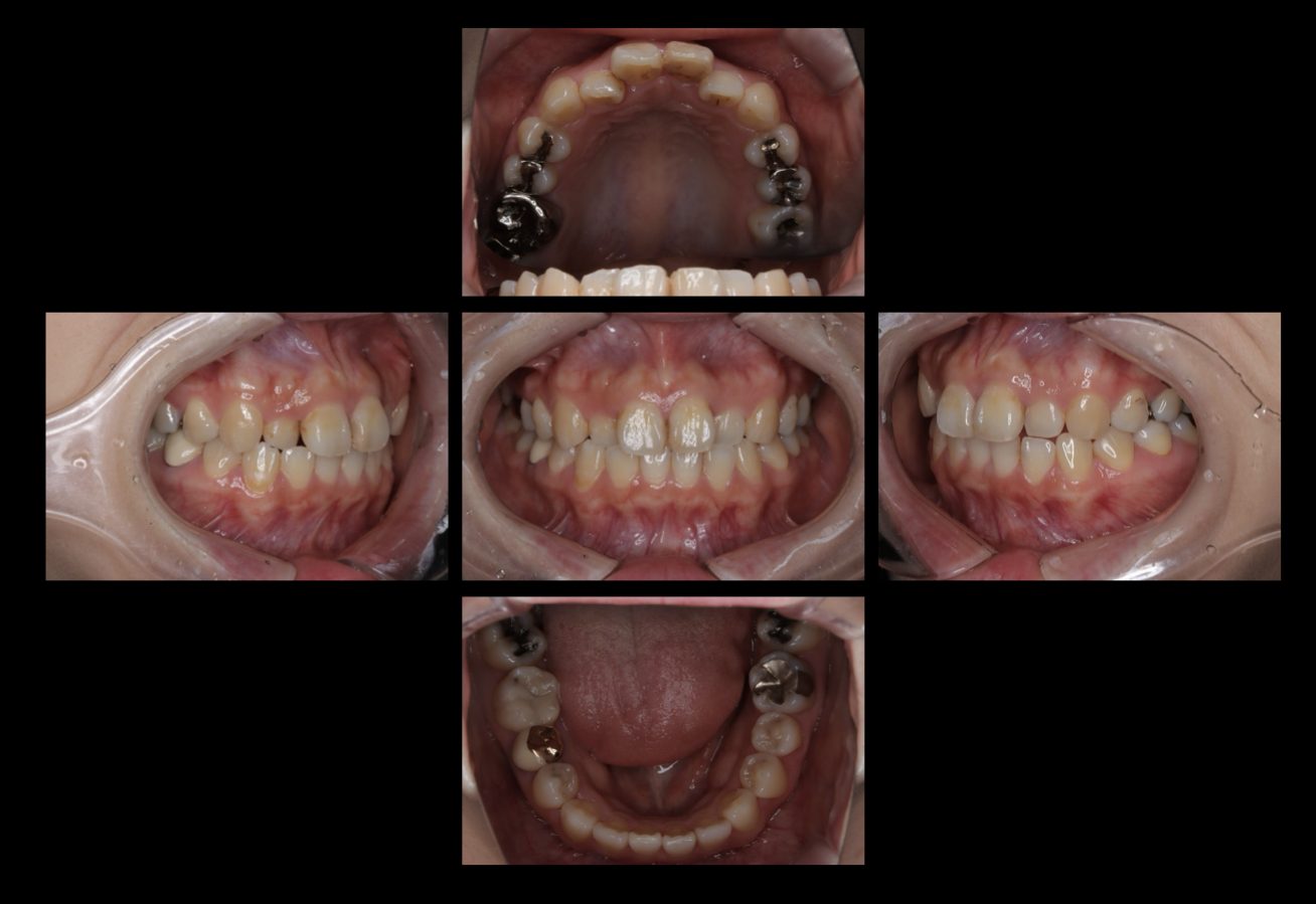 462インビザラインで歯並びを治療した症例