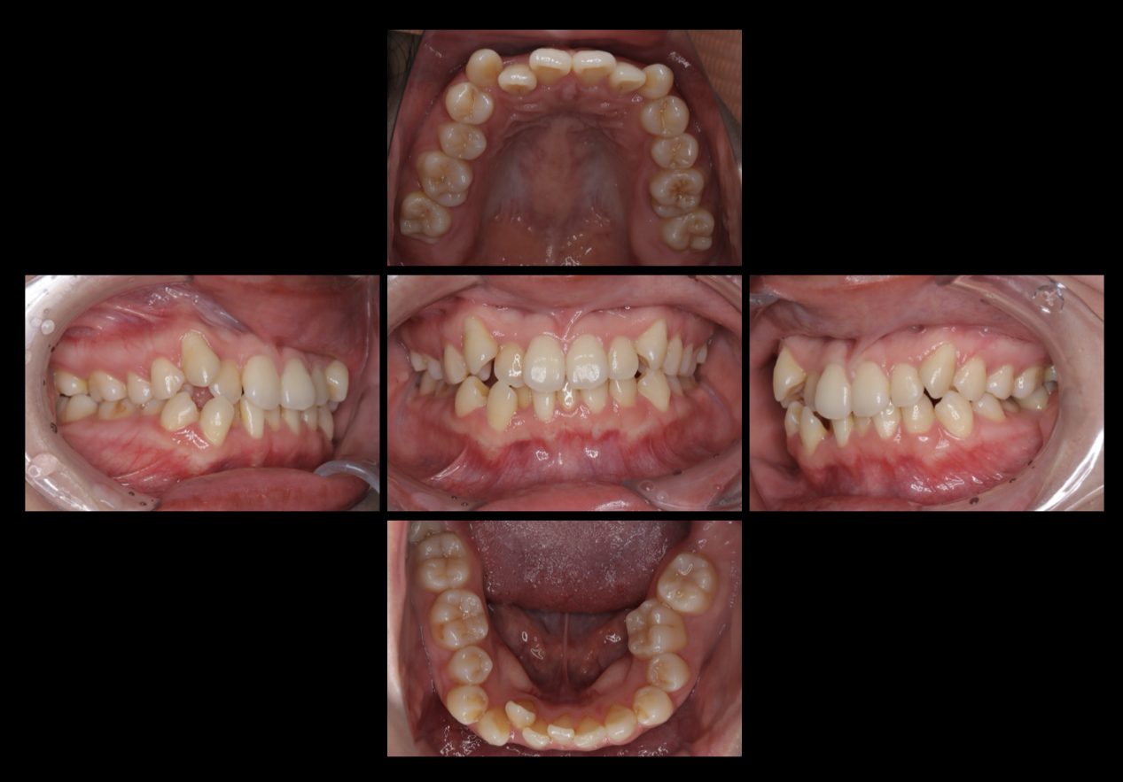 インビザライン（マウスピース矯正）　非抜歯症例