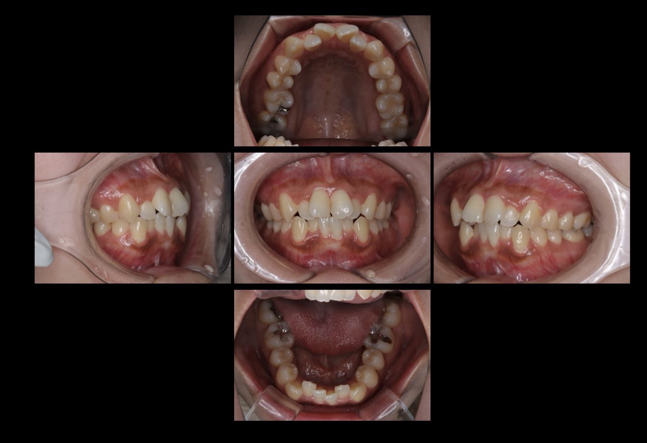 インビザラインGo（部分矯正）　症例