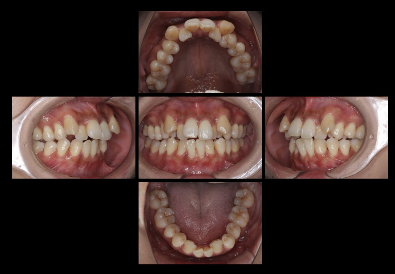 インビザライン（マウスピース矯正）で抜歯をして治療を行なった症例