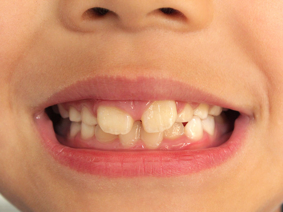 “歯の生え変わり時期”のトラブルに注意