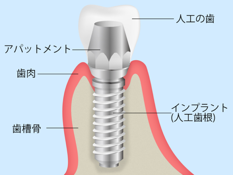 インプラントの構造