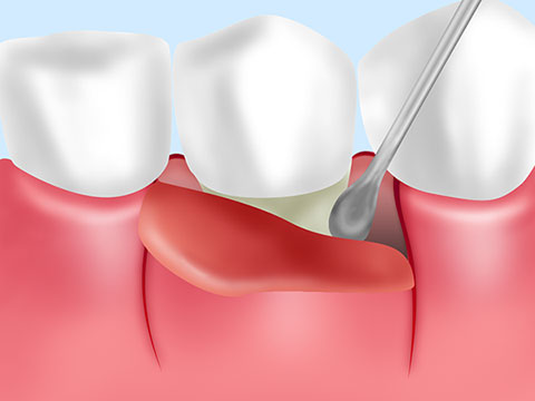 重度の歯周病　歯周外科治療